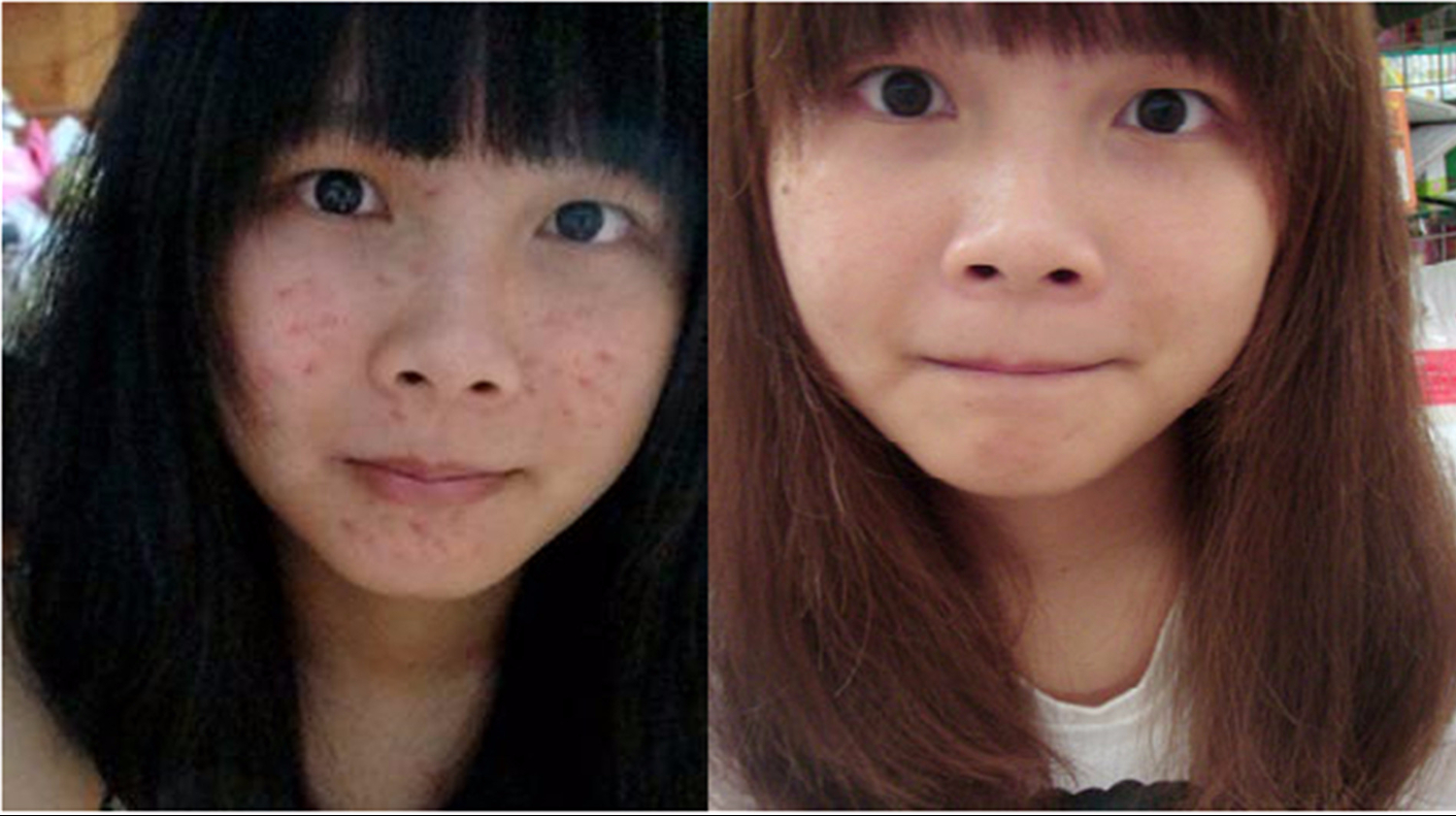 如何去除痘印，全面解析痘印消除方法，全面解析，痘印消除攻略，重塑肌膚無(wú)暇美！