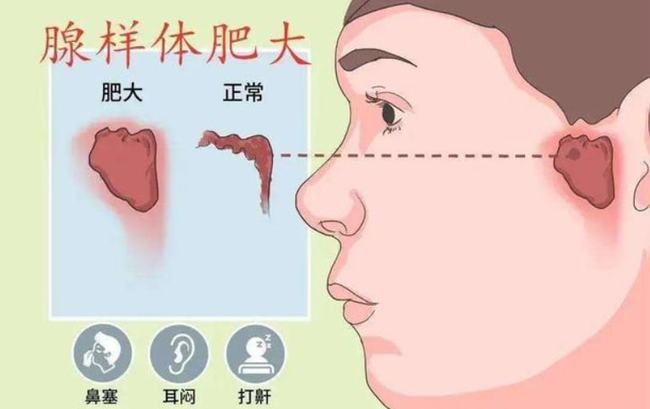 腺樣體肥大能自愈嗎？——深度解析與理解，腺樣體肥大能否自愈？全面深度解析