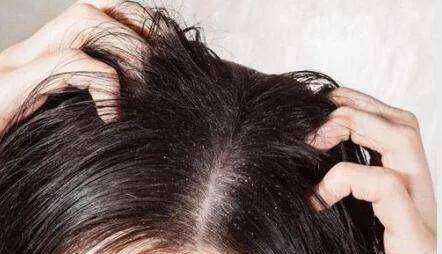 頭皮屑多怎么辦小妙招，全方位解決頭皮問題，全方位解決頭皮問題，頭皮屑多的小妙招匯總