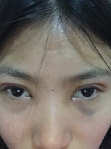 關(guān)于開眼角與割雙眼皮手術(shù)費用解析，究竟需要多少錢？，開眼角與割雙眼皮手術(shù)費用全解析，究竟要花多少錢？