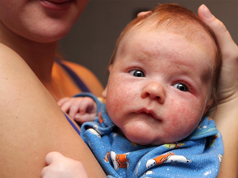 兒童常見的幾種疹子及其識(shí)別與處理方法，兒童常見疹子類型、識(shí)別與處理方法指南
