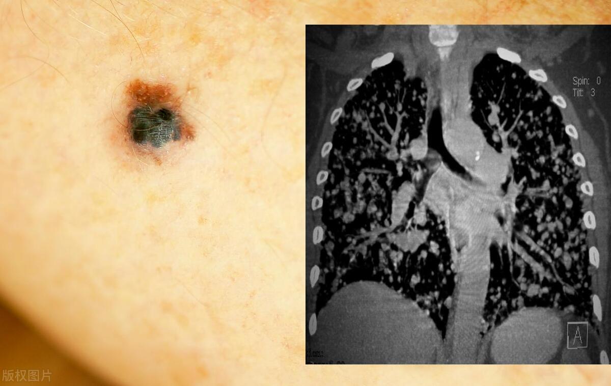 惡性黑色素痣初期的識別與應(yīng)對，惡性黑色素痣初期識別與防治攻略