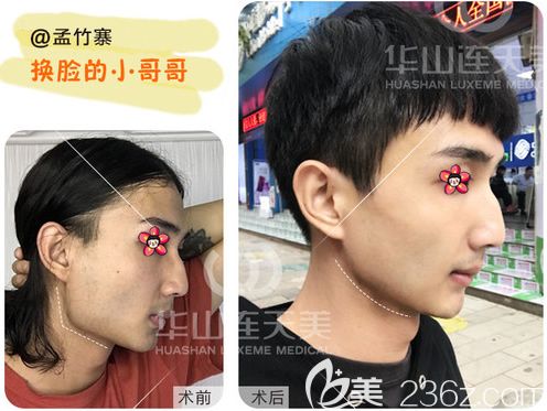 削顴骨手術(shù)費(fèi)用詳解，手術(shù)費(fèi)用大概要多少錢(qián)？，削顴骨手術(shù)費(fèi)用詳解，手術(shù)費(fèi)用及預(yù)算指南