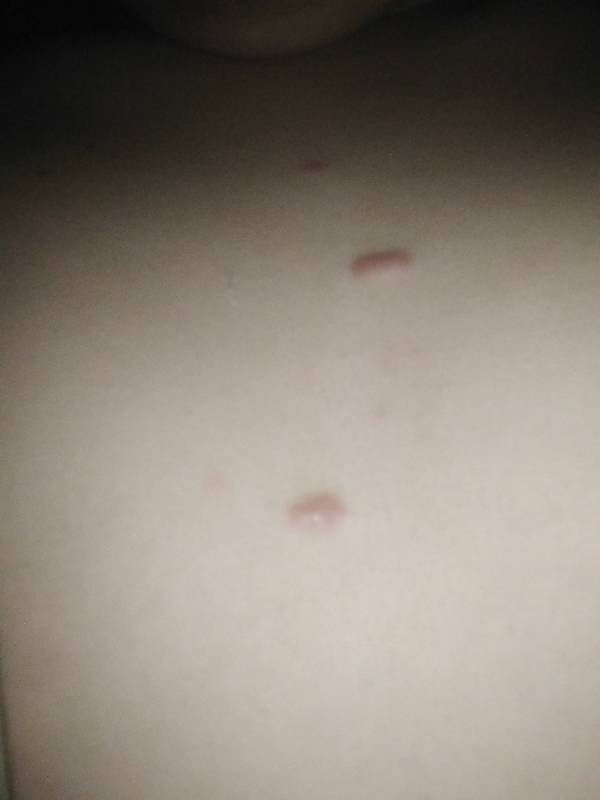 下面長(zhǎng)了一個(gè)硬疙瘩一碰就疼，原因、診斷與治療方法，私密部位硬疙瘩，成因、診斷與治療方法