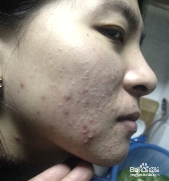 如何快速消除痤瘡，全面解析及實(shí)用建議，全面解析消除痤瘡秘訣，實(shí)用方法與建議助你快速告別肌膚困擾