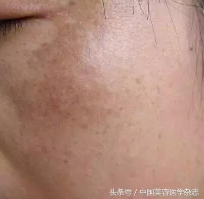 黃褐斑怎么治療最有效，全面解析最佳療法，全面解析黃褐斑最佳治療方法，最有效的療法選擇