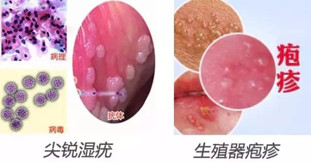 男性尖銳濕疣初期圖片及其相關(guān)解析，男性尖銳濕疣初期圖片及癥狀解析
