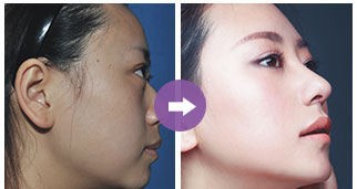 關(guān)于只做鼻翼縮小手術(shù)的費用分析，只做鼻翼縮小手術(shù)的費用詳解