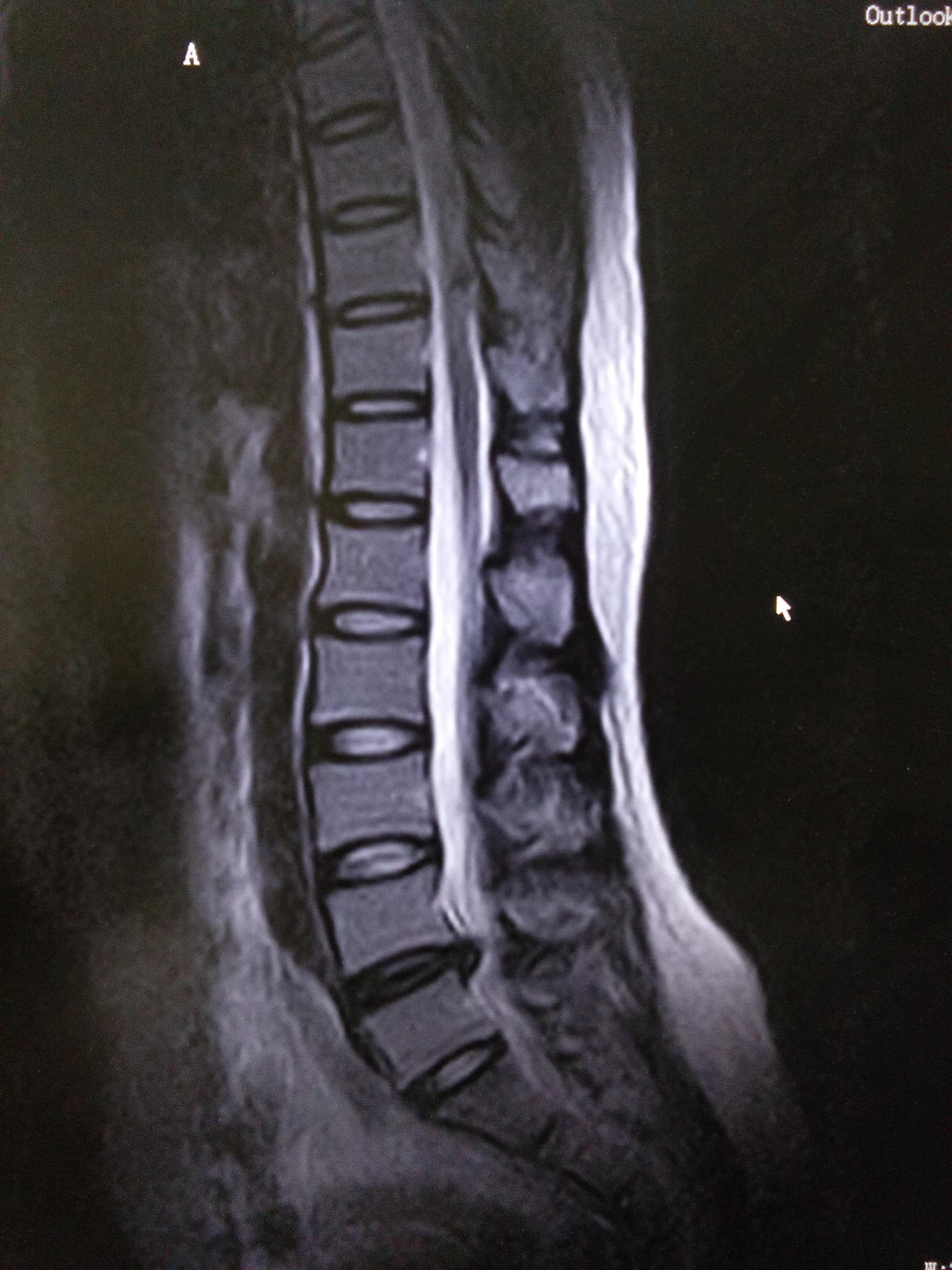 三天快速緩解腰間盤問題的方法，三天快速緩解腰間盤問題秘訣