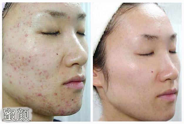 如何祛痘消除痘印——你的肌膚完美指南，完美肌膚指南，祛痘與消除痘印的方法