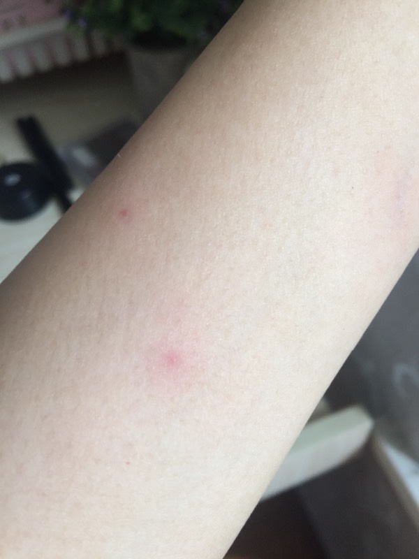 身上紅點(diǎn)不痛不癢圖片，原因、識(shí)別與處理方法，身上紅點(diǎn)無(wú)痛癢，識(shí)別、原因及處理方法