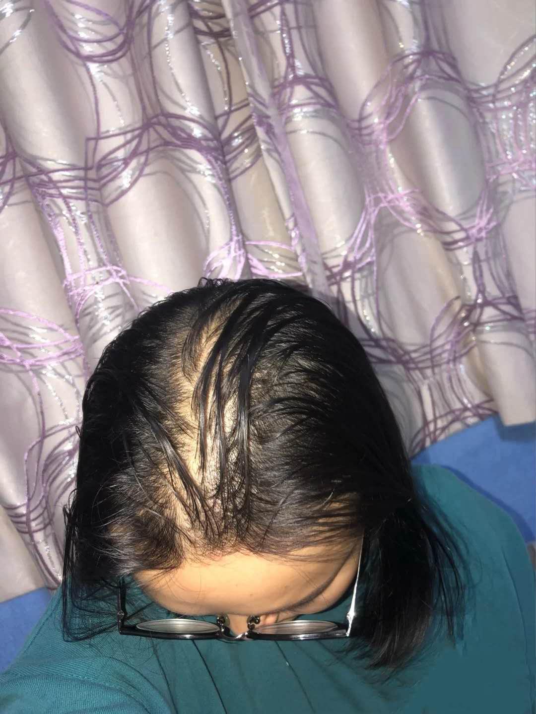 女性嚴重脫發(fā)，疾病先兆與防治策略，女性嚴重脫發(fā)，疾病預警與防治策略