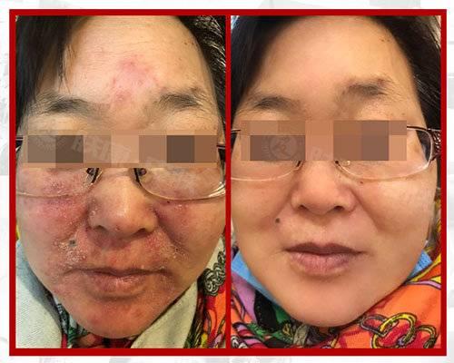 臉部過敏如何迅速消除，全面指南，臉部過敏迅速消除全面指南