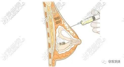 玻尿酸豐胸要打多少支，全面解析玻尿酸豐胸與注射次數(shù)的關(guān)系，全面解析，玻尿酸豐胸所需注射次數(shù)與效果揭秘