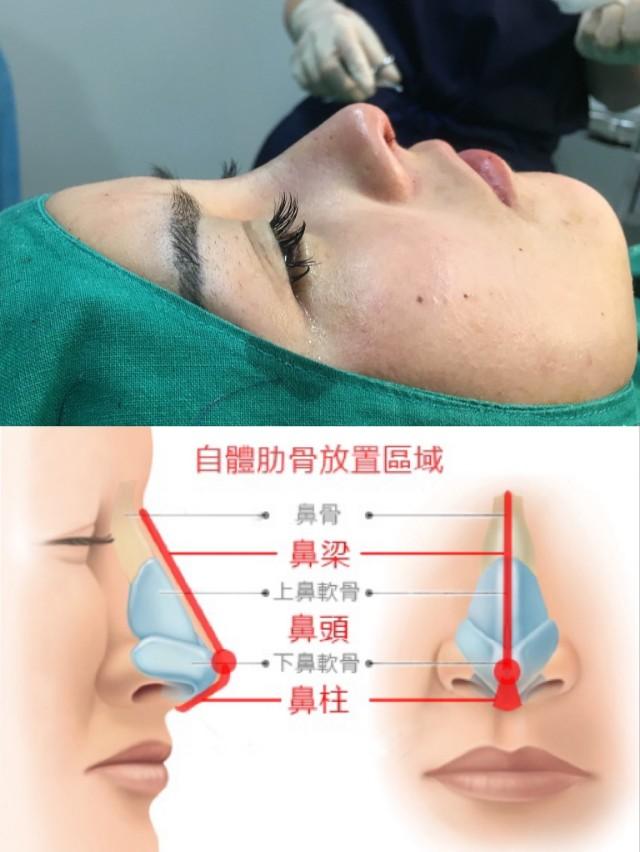 鼻綜合整形項(xiàng)目詳解，包括哪些項(xiàng)目？，鼻綜合整形項(xiàng)目詳解，涵蓋內(nèi)容與整形項(xiàng)目概覽