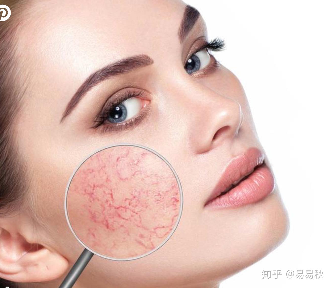 改善面部紅血絲的方法，改善面部紅血絲的有效方法