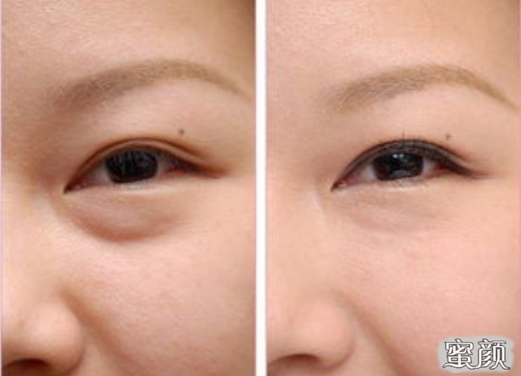 如何消除眼袋，簡單實(shí)用的方法，消除眼袋的實(shí)用方法與技巧