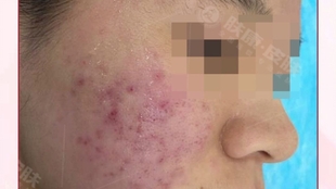 治療痤瘡的費(fèi)用分析，了解花費(fèi)多少以及背后的因素，治療痤瘡的費(fèi)用詳解，了解花費(fèi)背后的因素