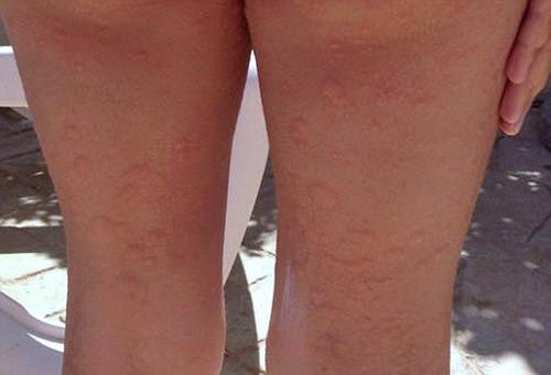 蕁麻疹的治療方法，全方位解析與應(yīng)對策略，全方位解析蕁麻疹治療方法與應(yīng)對策略