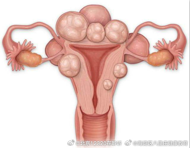 子宮肌瘤的最佳治療方法，全面解析與指導，子宮肌瘤的最佳治療方法詳解與指導手冊