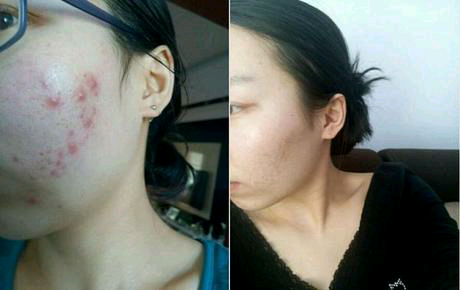 長青春痘怎么處理最好？全面解析最佳應(yīng)對策略，全面解析青春痘最佳應(yīng)對策略，最佳處理方法與建議