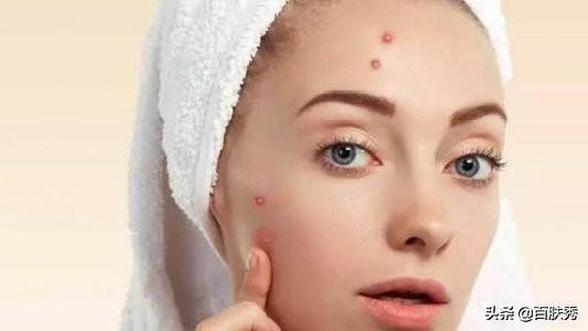 痤瘡是什么——深入了解痤瘡的成因、癥狀與治療方法，痤瘡解析，成因、癥狀及治療方法全面介紹