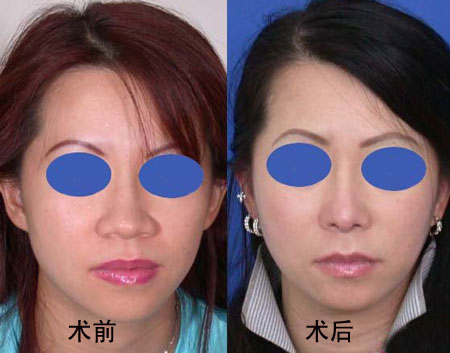 縮鼻翼手術(shù)風(fēng)險(xiǎn)分析，風(fēng)險(xiǎn)大嗎？，縮鼻翼手術(shù)風(fēng)險(xiǎn)詳解，手術(shù)風(fēng)險(xiǎn)是否大？