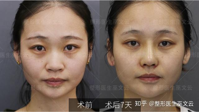 縮鼻翼手術(shù)，重塑美麗鼻型的最佳選擇，縮鼻翼手術(shù)，重塑美麗鼻型的優(yōu)選之道