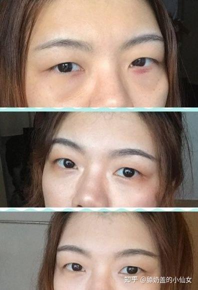 醫(yī)美去眼袋，價格因素與選擇策略，醫(yī)美去眼袋，價格因素詳解與選擇策略指南